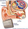 Implante auditivo